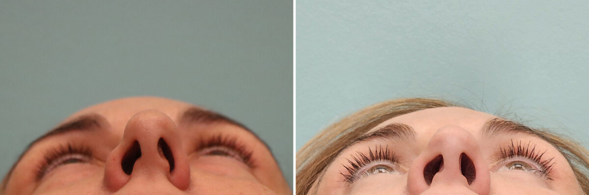 Before and after Rhinoplasty by Dr. Shervin Naderi, Patient 49451