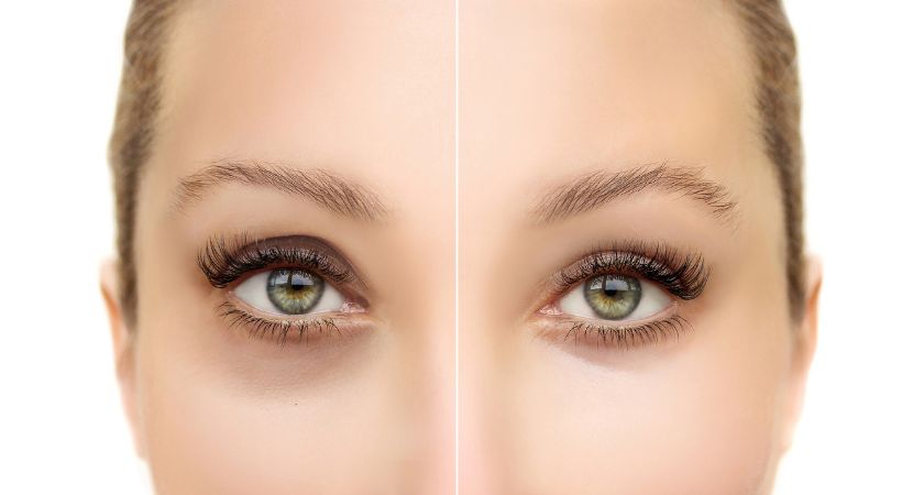 Before and after comparison of under-eye area showing improvement in dark circles and skin quality with PRF treatment.