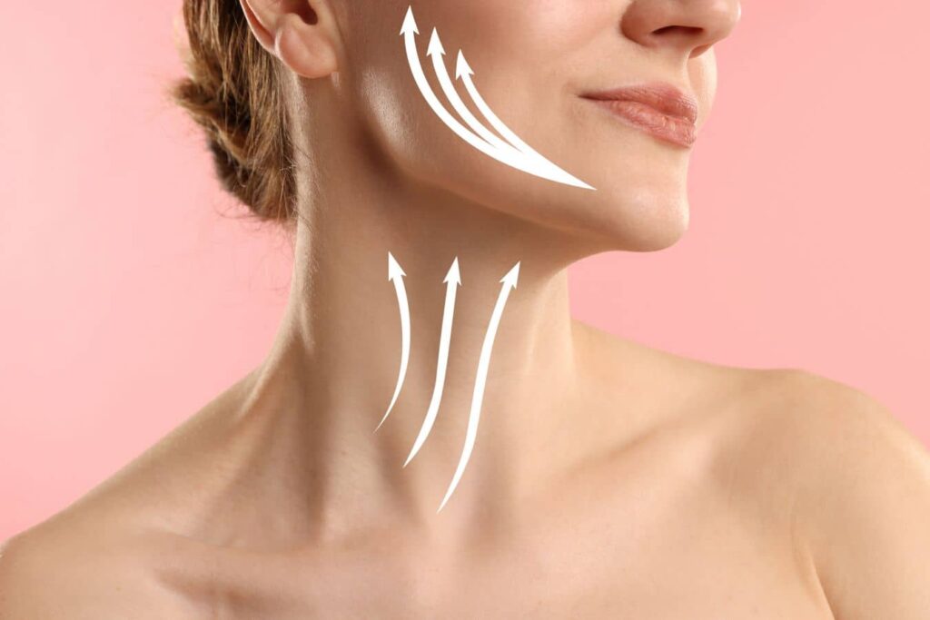 Close-up of jawline and neck with arrows showing upward lift from deep plane facelift technique.