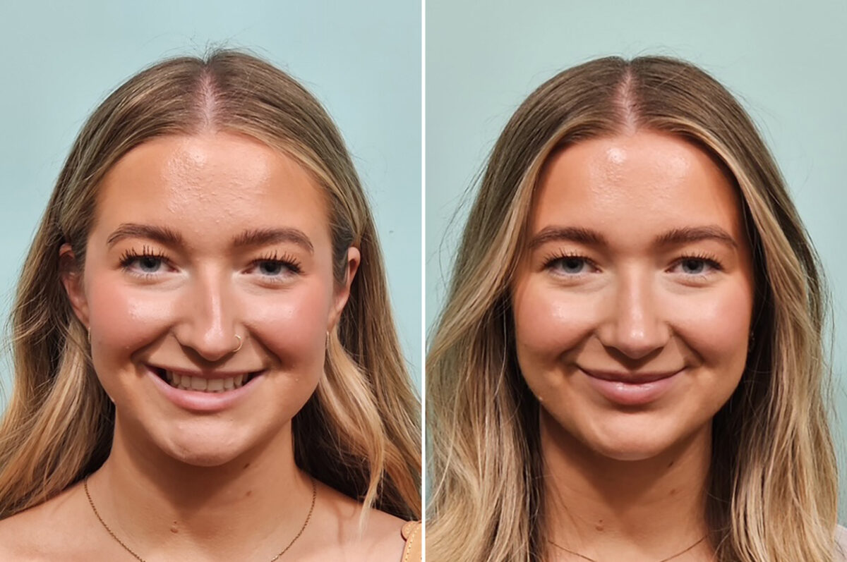 Before and after Rhinoplasty by Dr. Shervin Naderi, Patient 49734