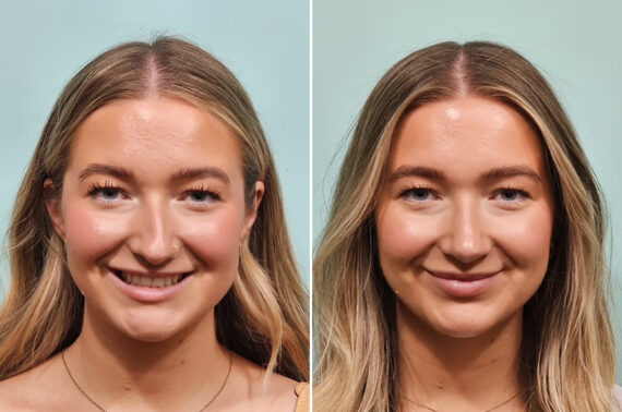 Before and after Rhinoplasty by Dr. Shervin Naderi, Patient 49734