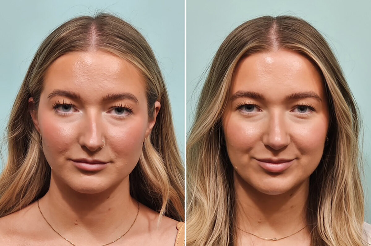 Before and after Rhinoplasty by Dr. Shervin Naderi, Patient 49734