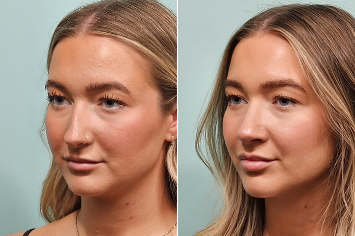 Before and after Rhinoplasty by Dr. Shervin Naderi, Patient 49734