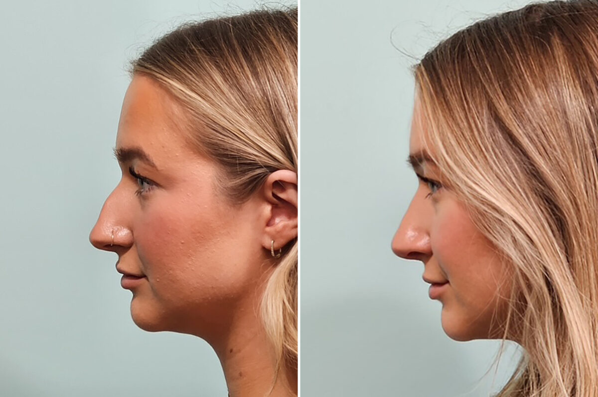 Before and after Rhinoplasty by Dr. Shervin Naderi, Patient 49734