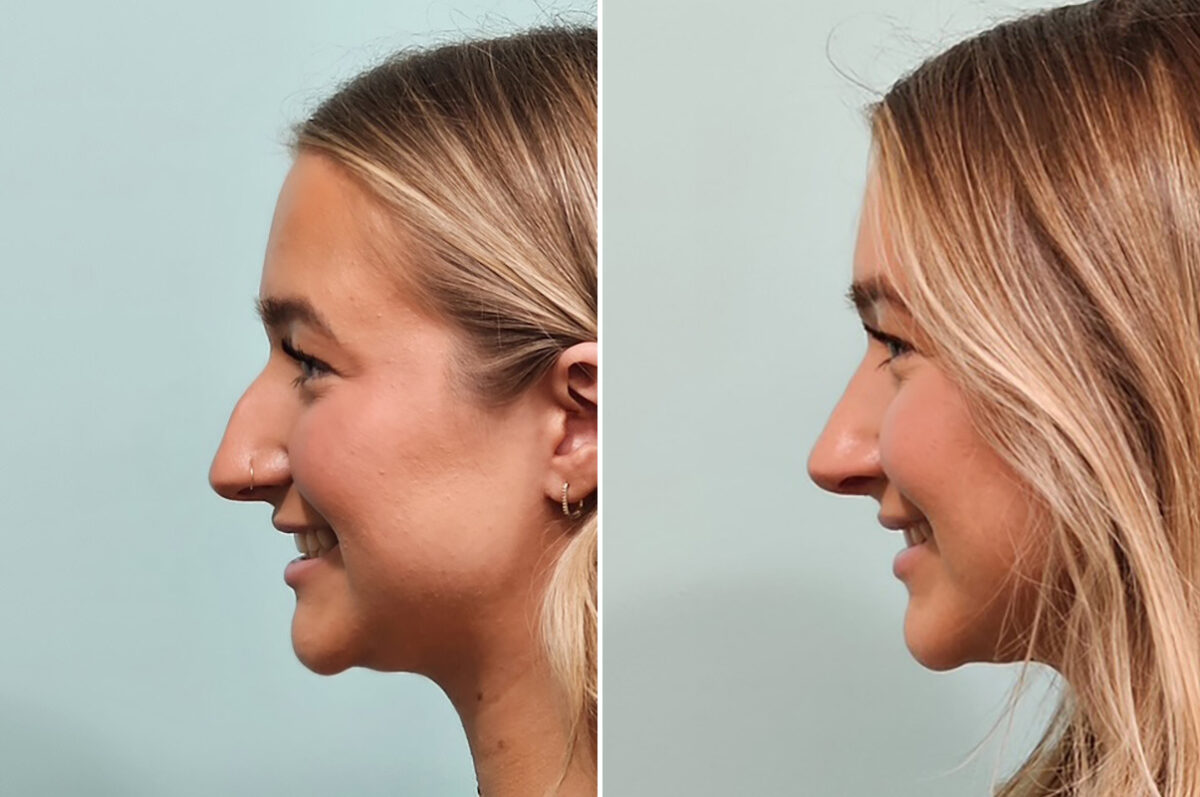 Before and after Rhinoplasty by Dr. Shervin Naderi, Patient 49734