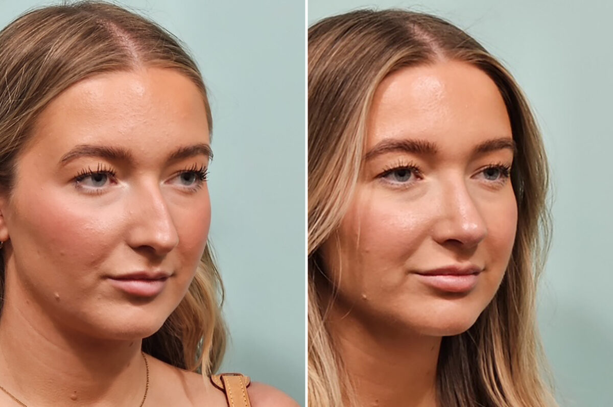 Before and after Rhinoplasty by Dr. Shervin Naderi, Patient 49734