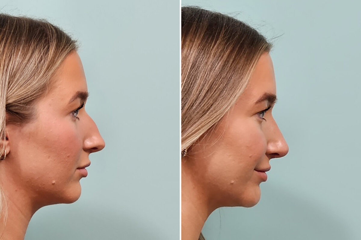 Before and after Rhinoplasty by Dr. Shervin Naderi, Patient 49734