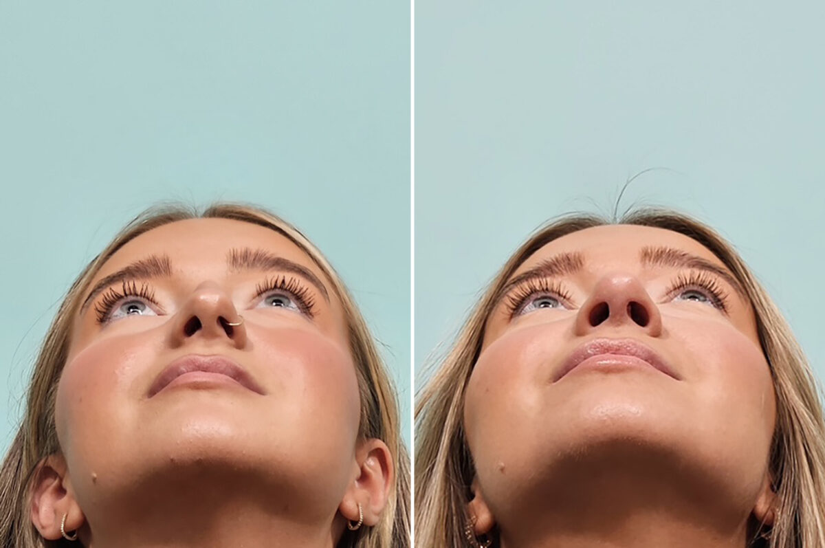 Before and after Rhinoplasty by Dr. Shervin Naderi, Patient 49734