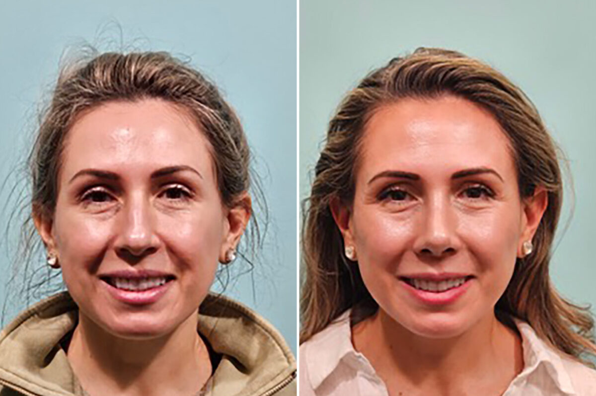 Before and after Rhinoplasty by Dr. Shervin Naderi, Patient 49759