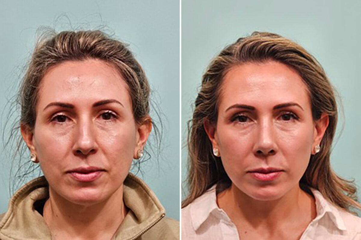 Before and after Rhinoplasty by Dr. Shervin Naderi, Patient 49759