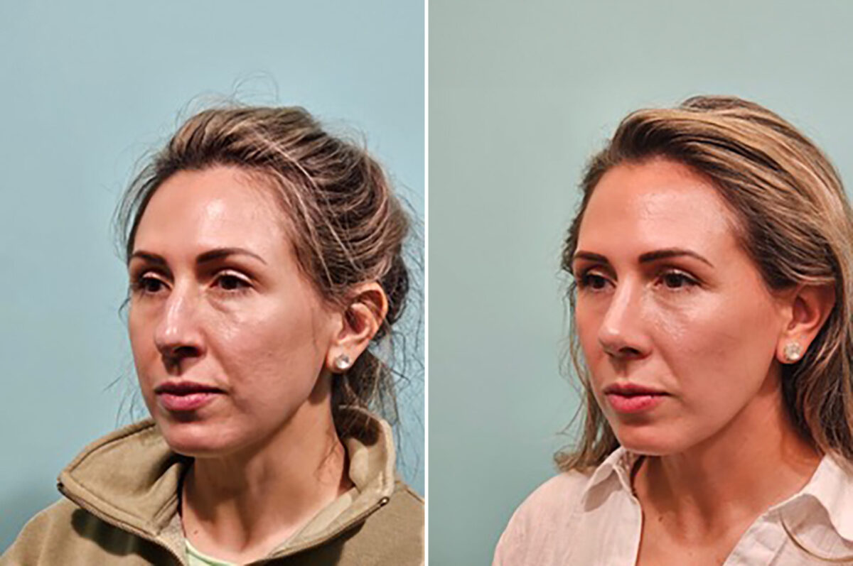 Before and after Rhinoplasty by Dr. Shervin Naderi, Patient 49759