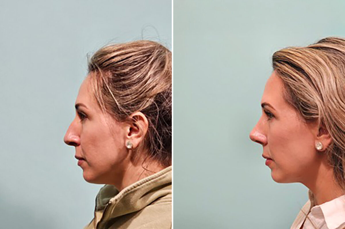 Before and after Rhinoplasty by Dr. Shervin Naderi, Patient 49759