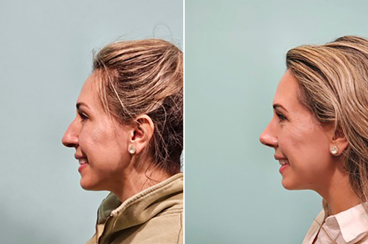 Before and after Rhinoplasty by Dr. Shervin Naderi, Patient 49759