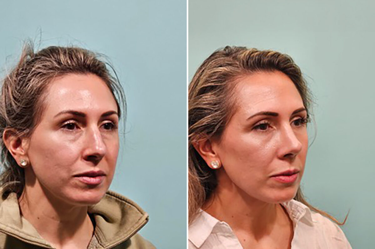 Before and after Rhinoplasty by Dr. Shervin Naderi, Patient 49759