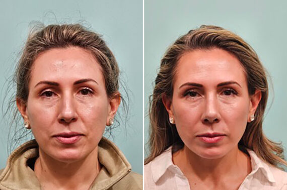 Before and after Rhinoplasty by Dr. Shervin Naderi, Patient 49759