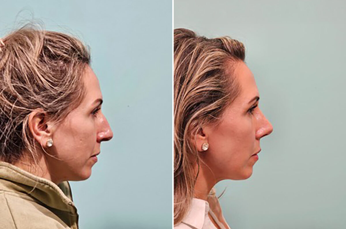Before and after Rhinoplasty by Dr. Shervin Naderi, Patient 49759