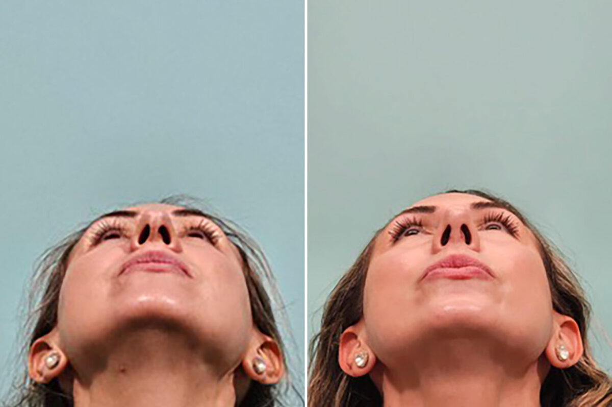 Before and after Rhinoplasty by Dr. Shervin Naderi, Patient 49759