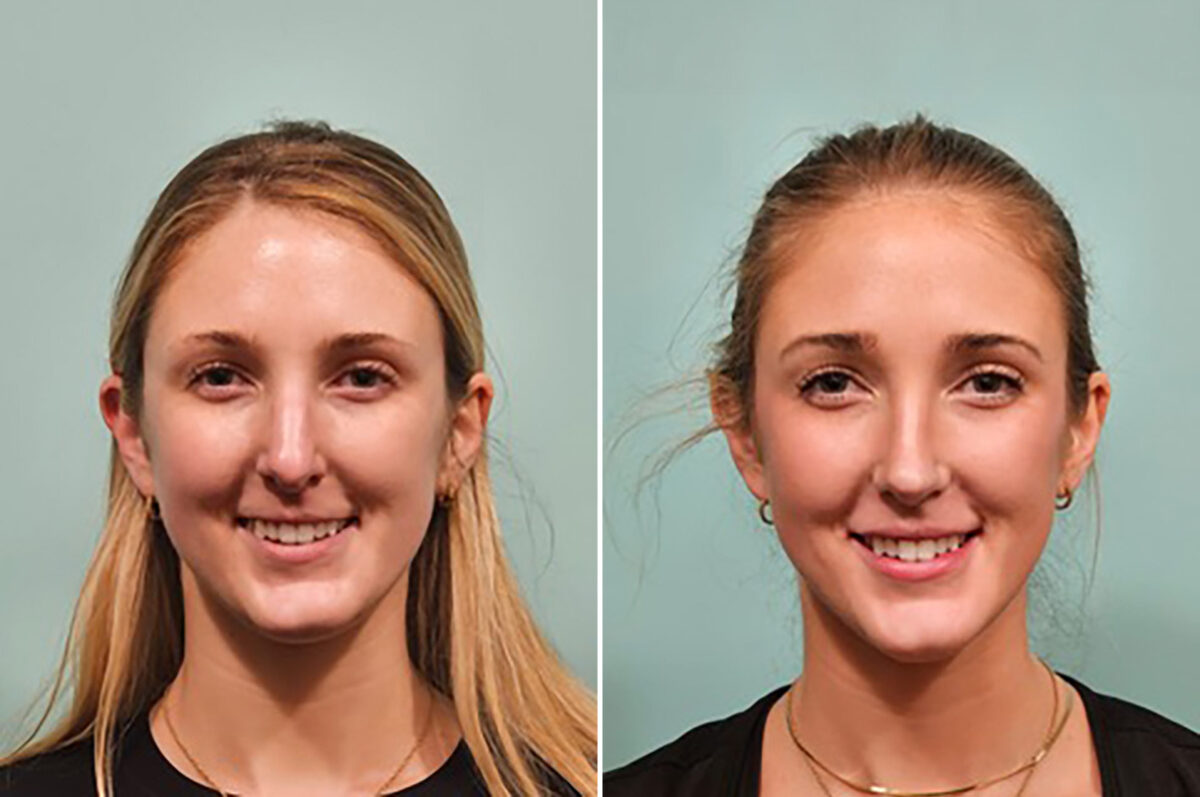 Before and after Rhinoplasty by Dr. Shervin Naderi, Patient 49784