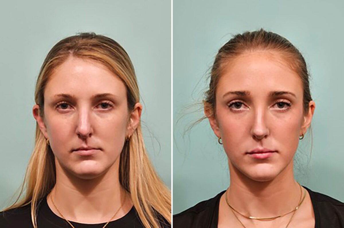 Before and after Rhinoplasty by Dr. Shervin Naderi, Patient 49784