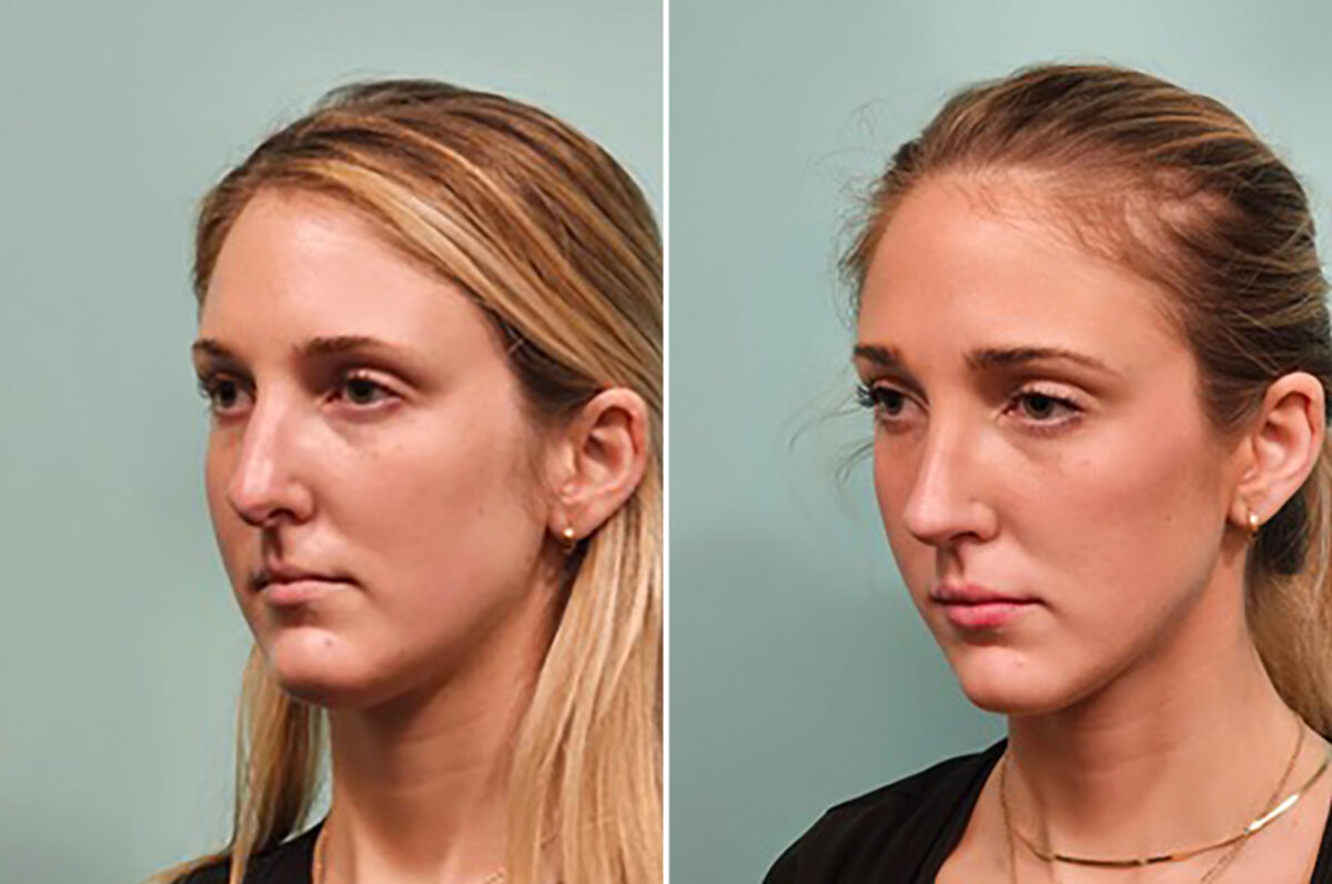 Before and after Rhinoplasty by Dr. Shervin Naderi, Patient 49784