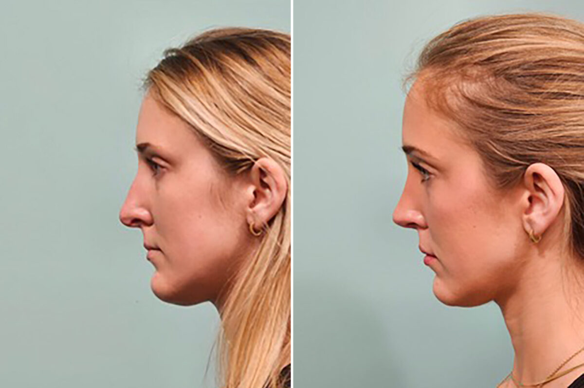 Before and after Rhinoplasty by Dr. Shervin Naderi, Patient 49784