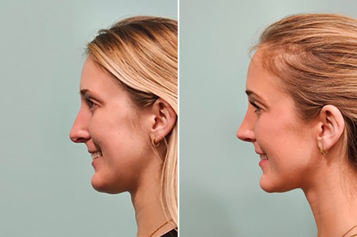 Before and after Rhinoplasty by Dr. Shervin Naderi, Patient 49784