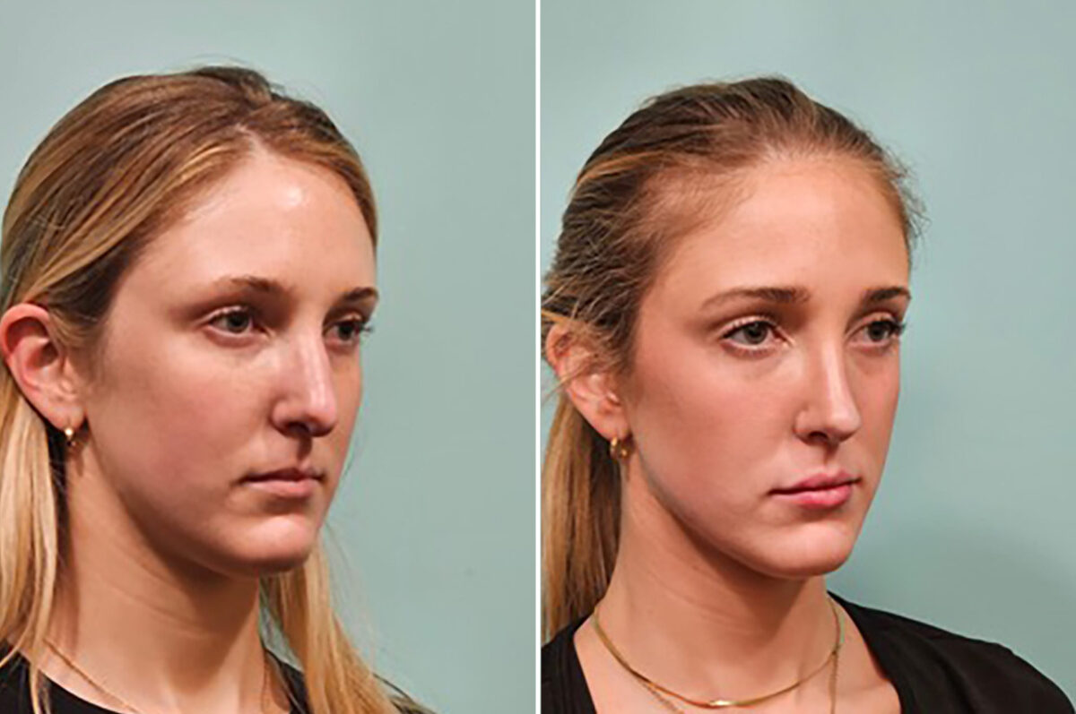 Before and after Rhinoplasty by Dr. Shervin Naderi, Patient 49784
