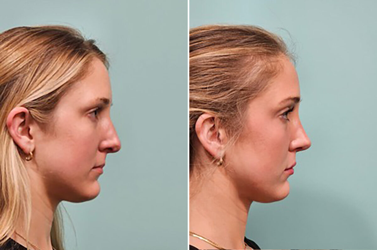 Before and after Rhinoplasty by Dr. Shervin Naderi, Patient 49784