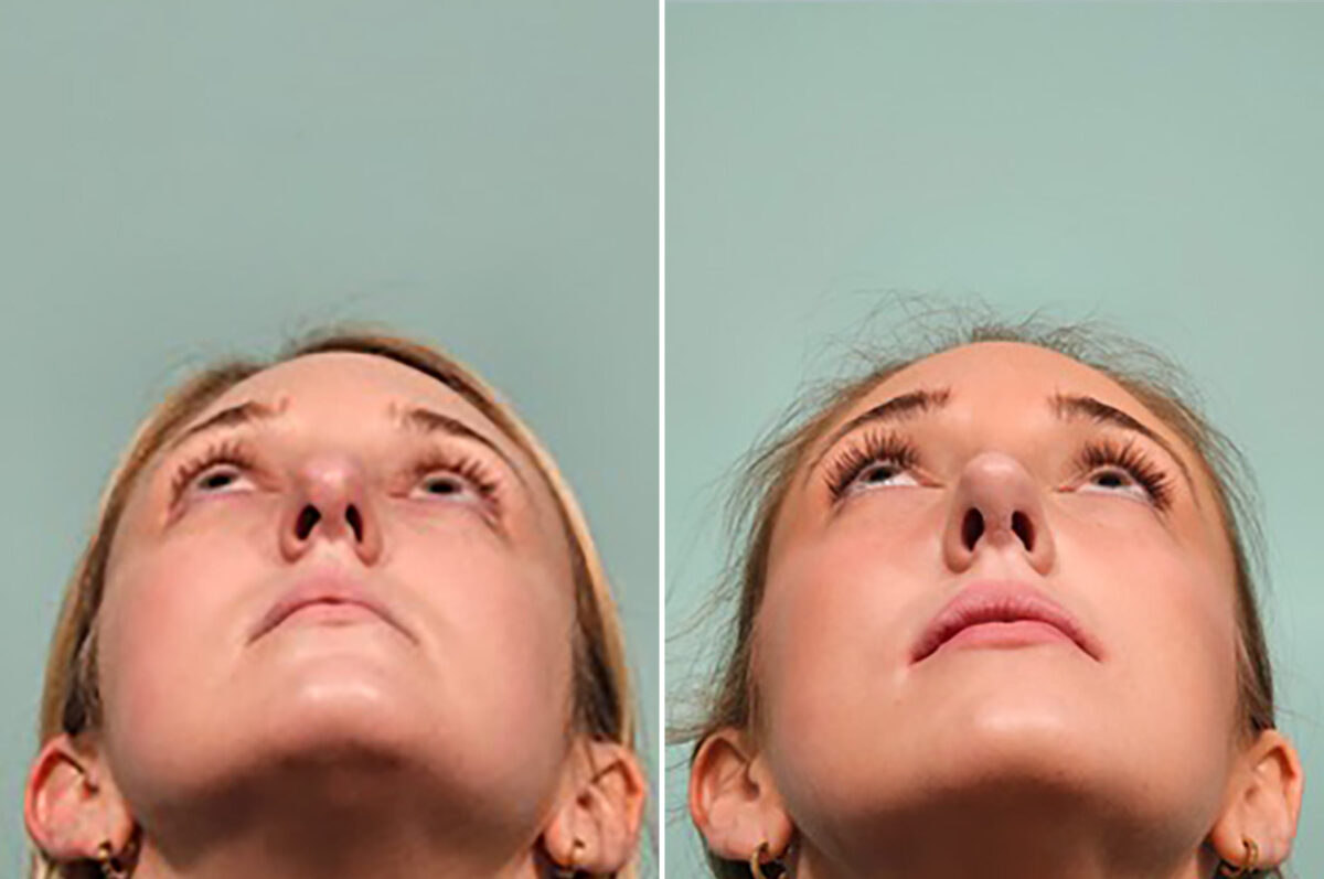 Before and after Rhinoplasty by Dr. Shervin Naderi, Patient 49784