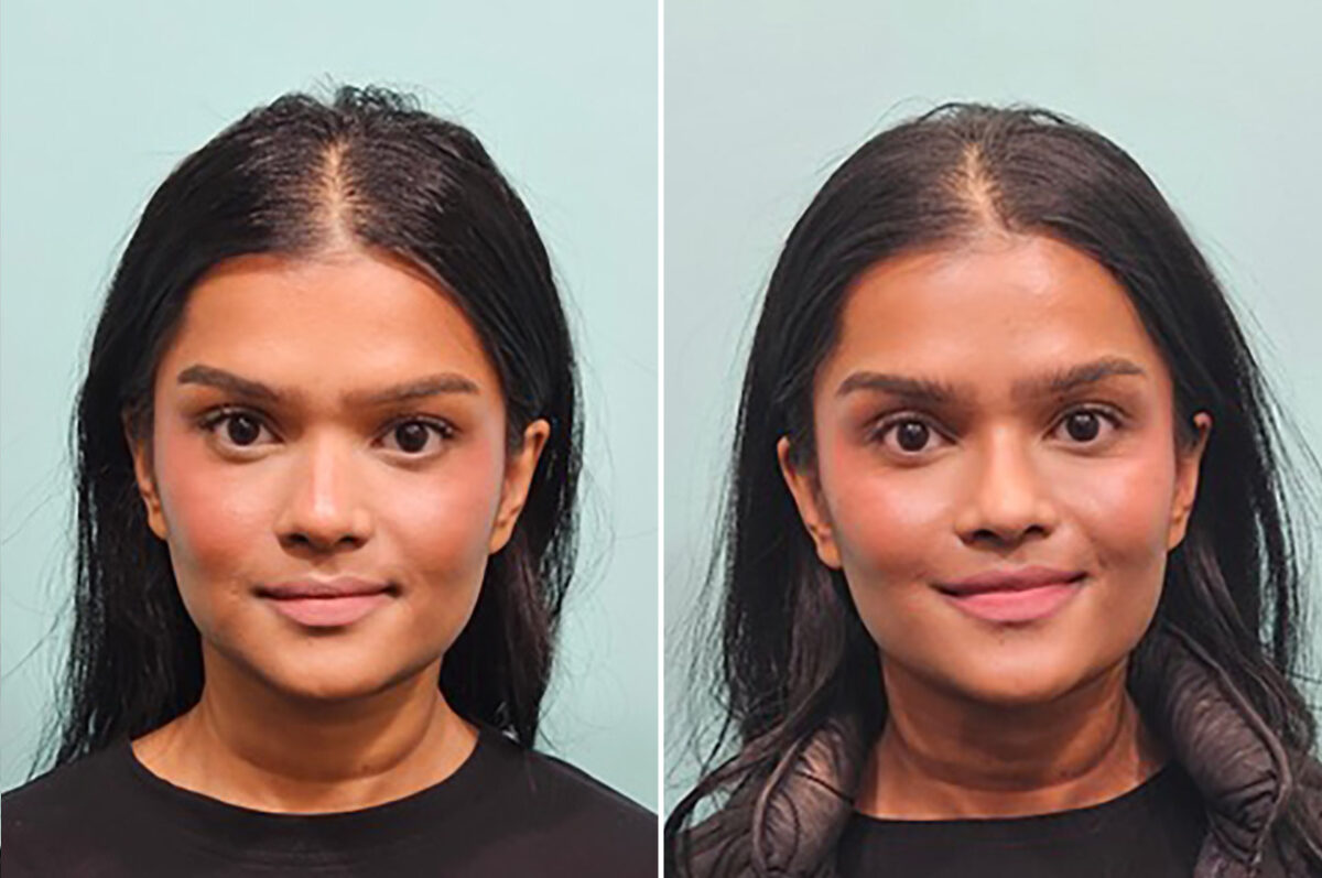 Before and after Rhinoplasty by Dr. Shervin Naderi, Patient 49809