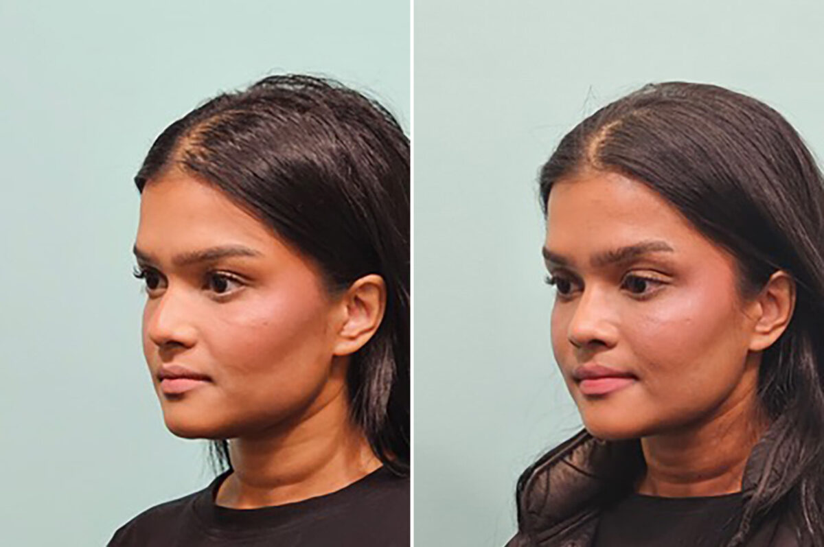 Before and after Rhinoplasty by Dr. Shervin Naderi, Patient 49809
