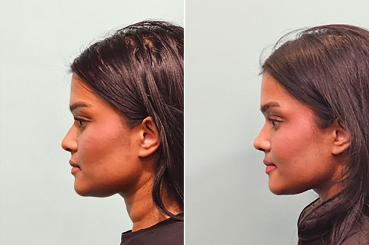 Before and after Rhinoplasty by Dr. Shervin Naderi, Patient 49809
