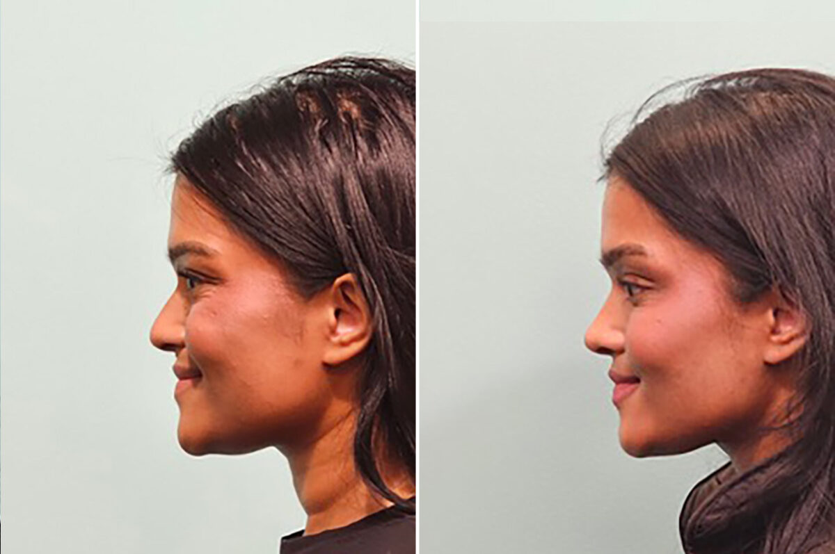 Before and after Rhinoplasty by Dr. Shervin Naderi, Patient 49809