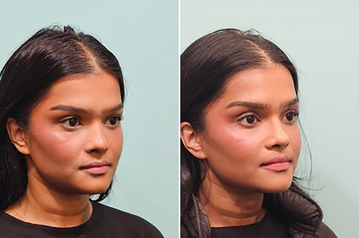 Before and after Rhinoplasty by Dr. Shervin Naderi, Patient 49809