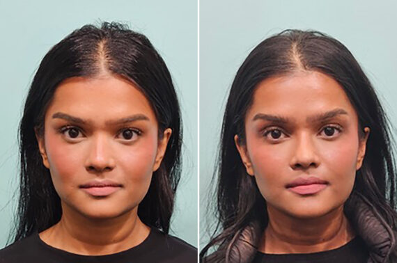 Before and after Rhinoplasty by Dr. Shervin Naderi, Patient 49809