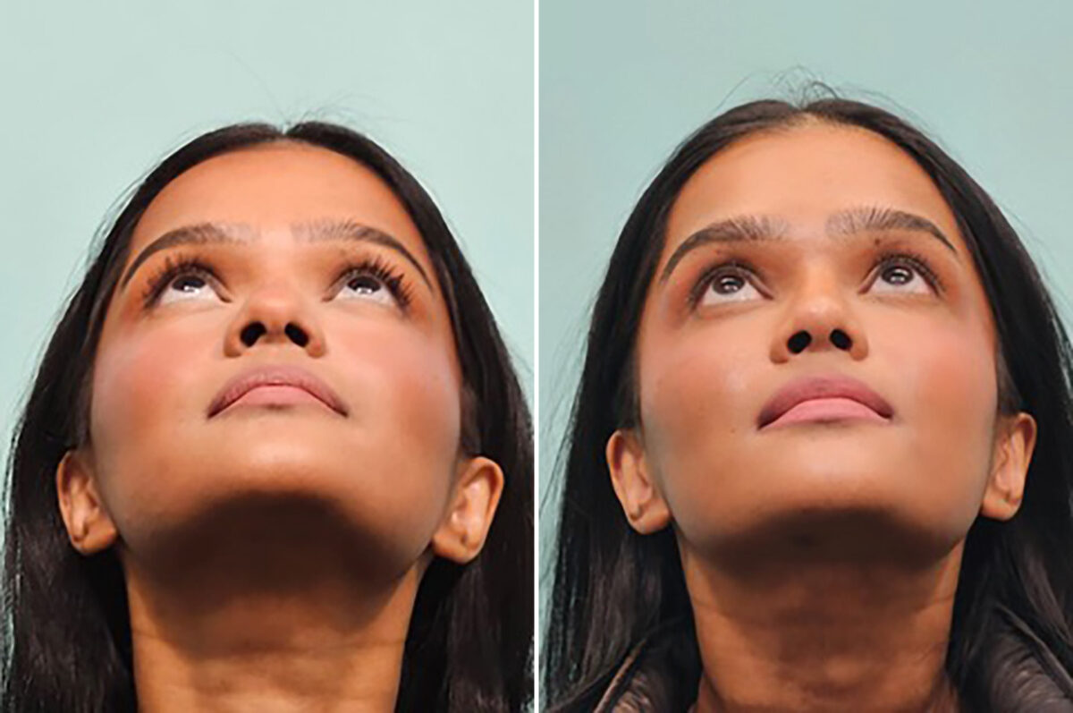 Before and after Rhinoplasty by Dr. Shervin Naderi, Patient 49809