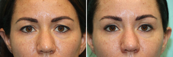 Before and after Blepharoplasty by Dr. Shervin Naderi, Patient 49850