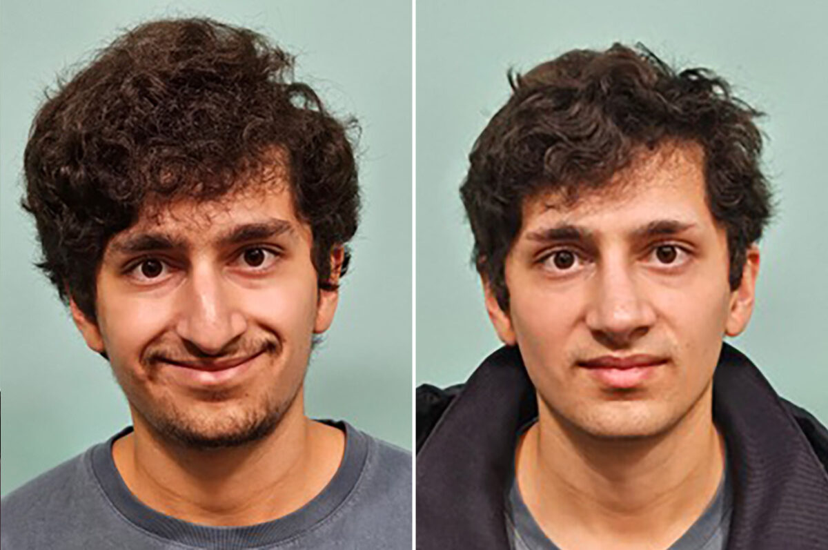 Before and after Rhinoplasty by Dr. Shervin Naderi, Patient 49855