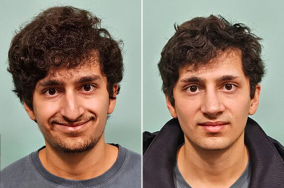 Before and after Rhinoplasty by Dr. Shervin Naderi, Patient 49855