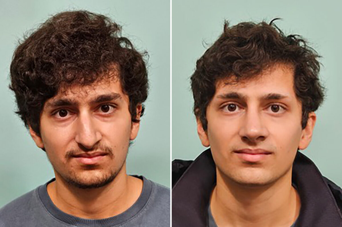 Before and after Rhinoplasty by Dr. Shervin Naderi, Patient 49855