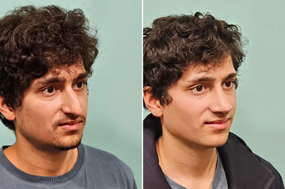 Before and after Rhinoplasty by Dr. Shervin Naderi, Patient 49855