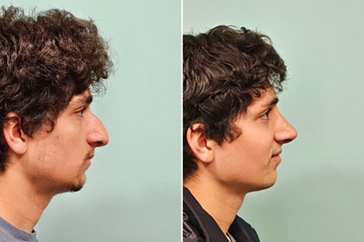 Before and after Rhinoplasty by Dr. Shervin Naderi, Patient 49855