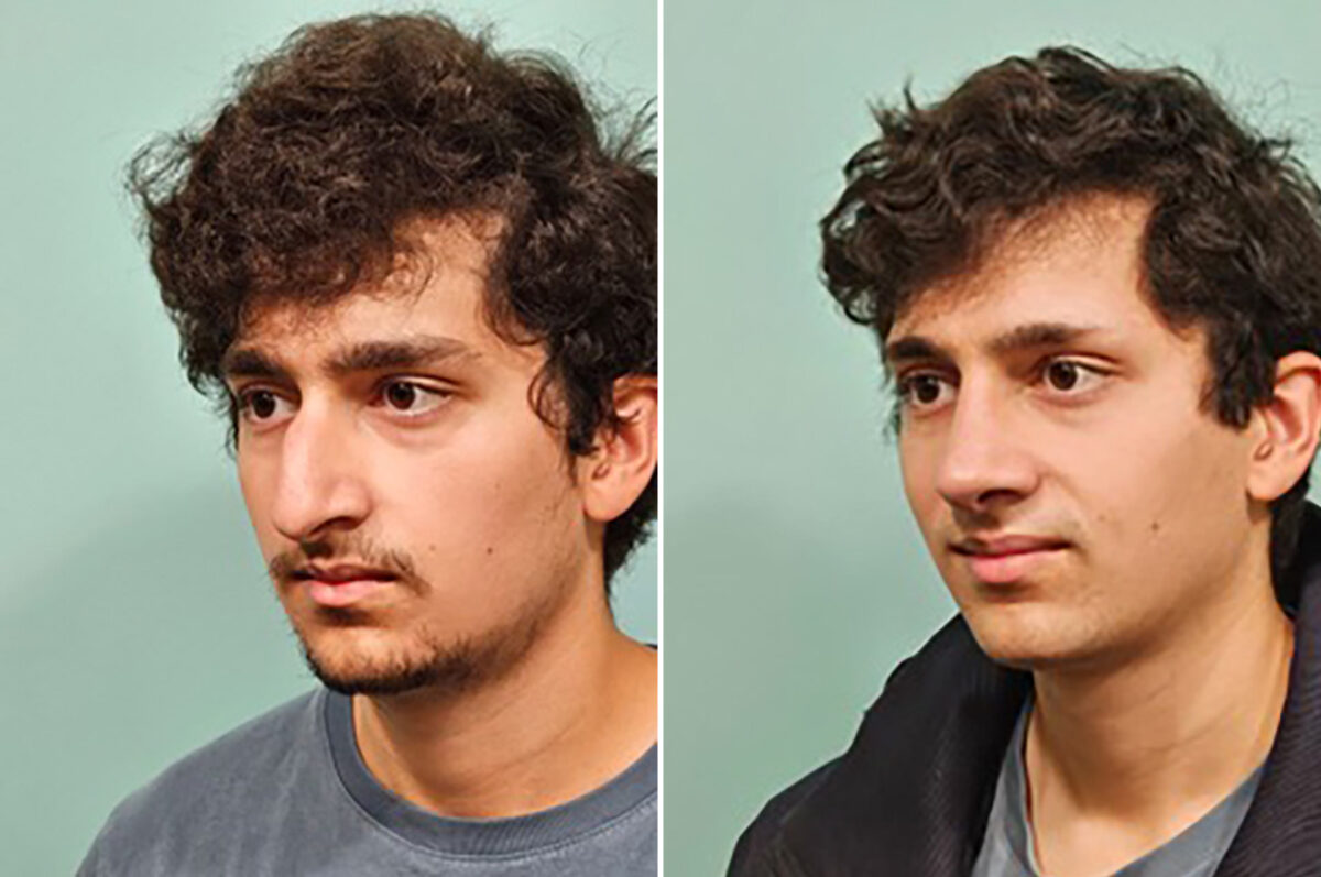 Before and after Rhinoplasty by Dr. Shervin Naderi, Patient 49855
