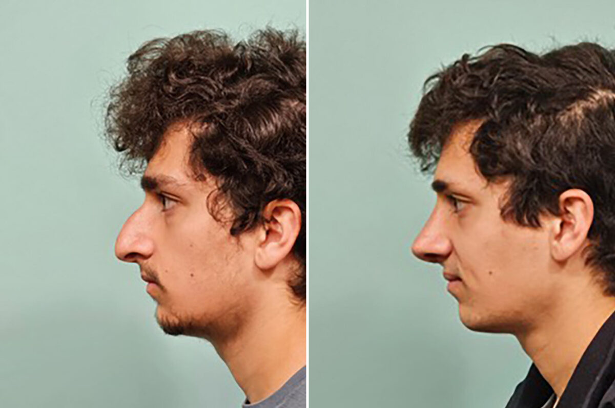 Before and after Rhinoplasty by Dr. Shervin Naderi, Patient 49855