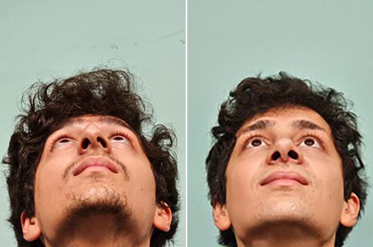 Before and after Rhinoplasty by Dr. Shervin Naderi, Patient 49855