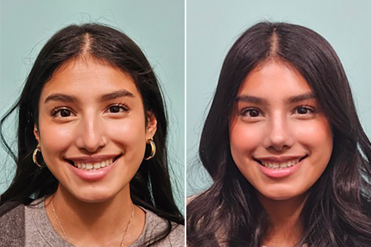 Before and after Rhinoplasty by Dr. Shervin Naderi, Patient 49893