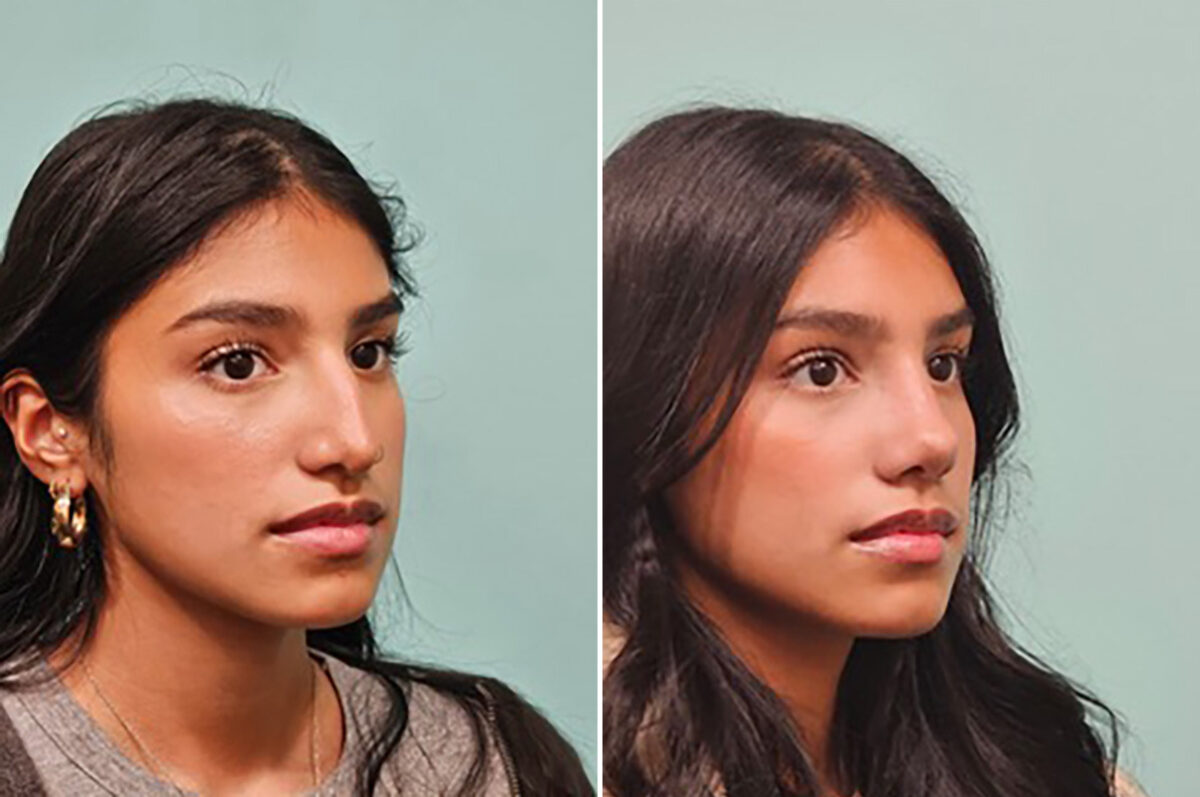 Before and after Rhinoplasty by Dr. Shervin Naderi, Patient 49893