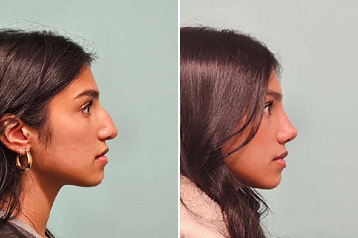 Before and after Rhinoplasty by Dr. Shervin Naderi, Patient 49893