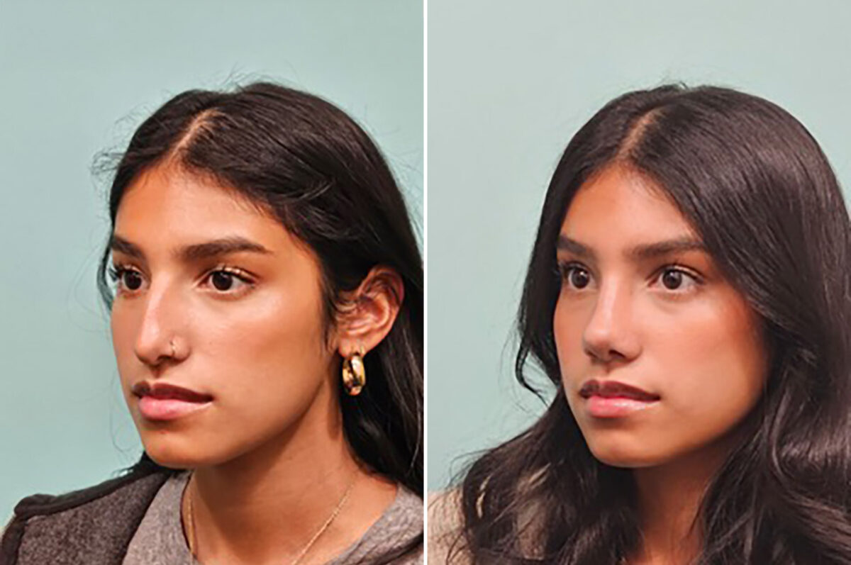 Before and after Rhinoplasty by Dr. Shervin Naderi, Patient 49893