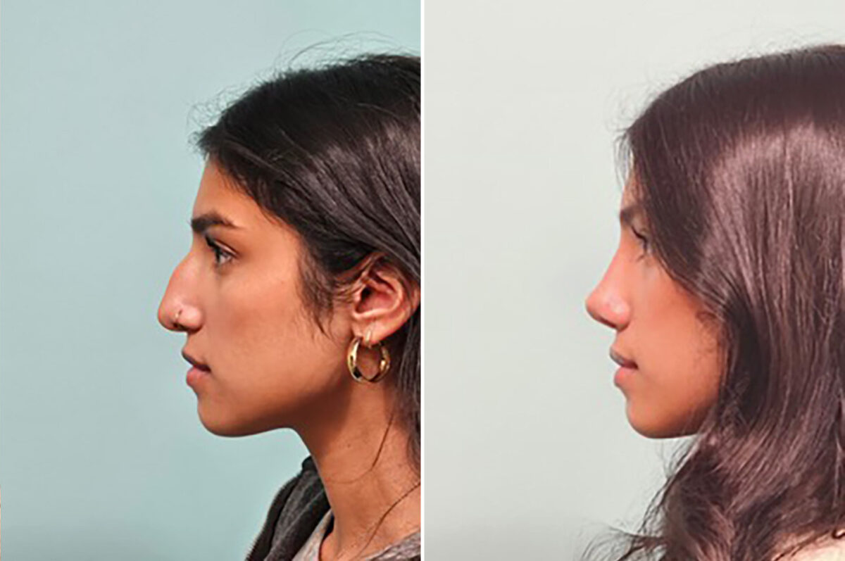 Before and after Rhinoplasty by Dr. Shervin Naderi, Patient 49893